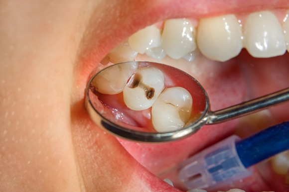 Dental Fillings 