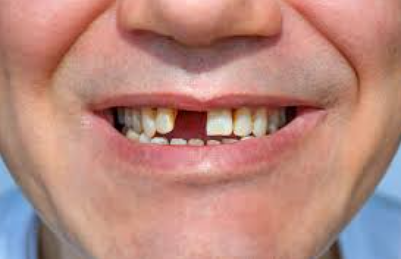 Missing Teeth
