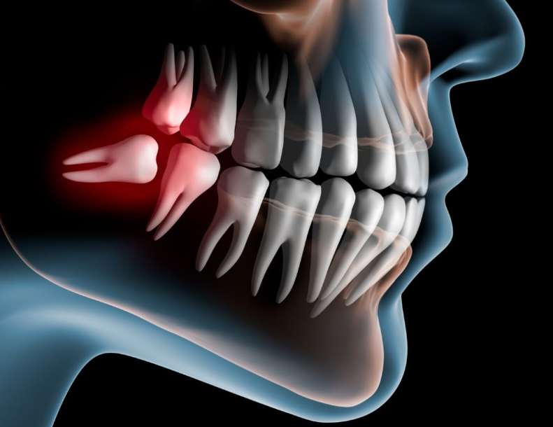 Pain in wisdom tooth