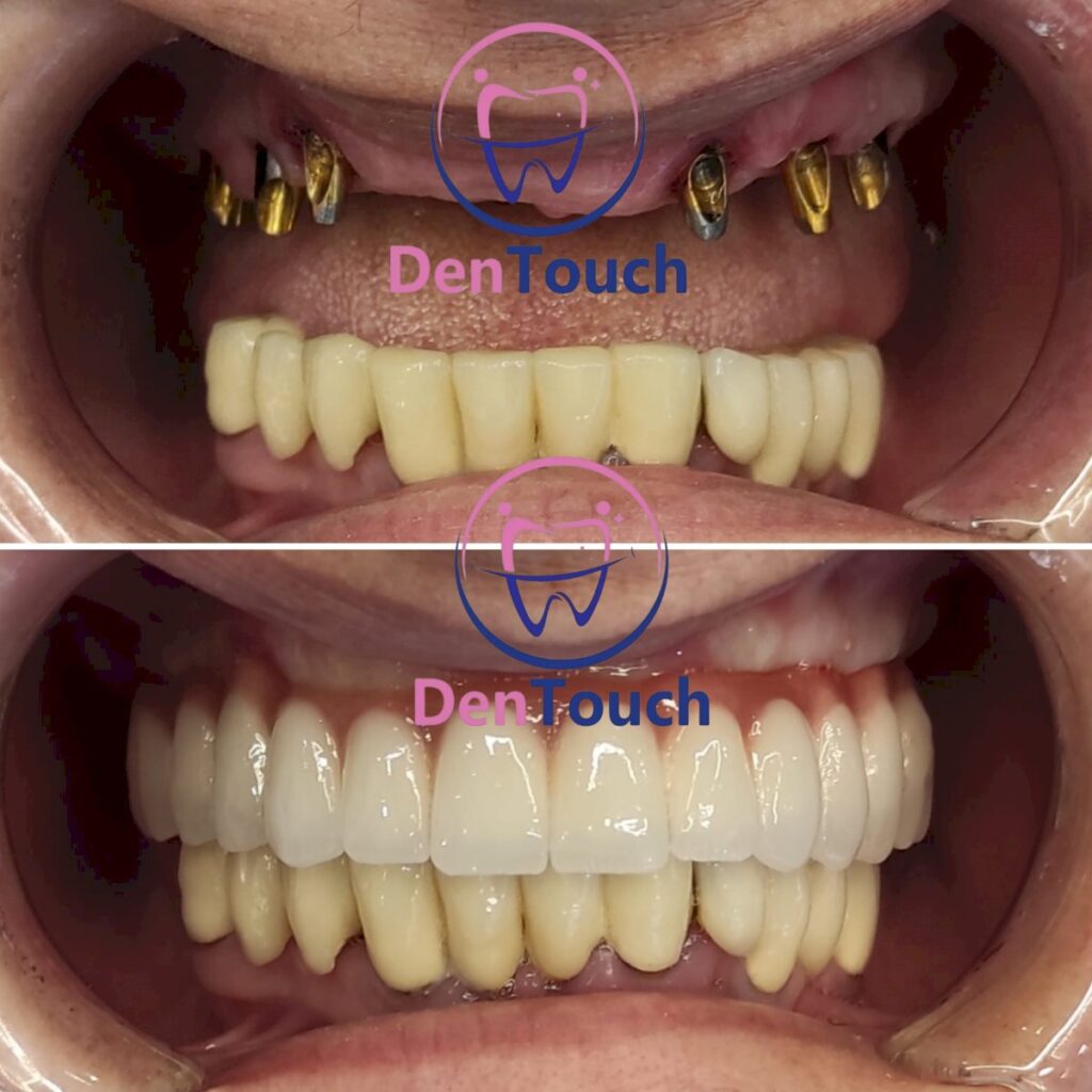 Dental Implants