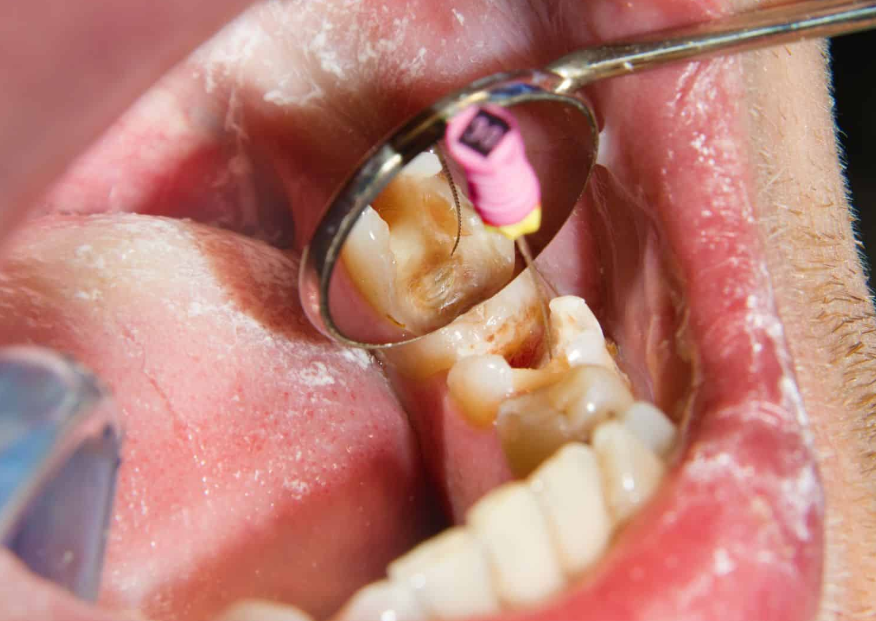 Root Canal Treatment
