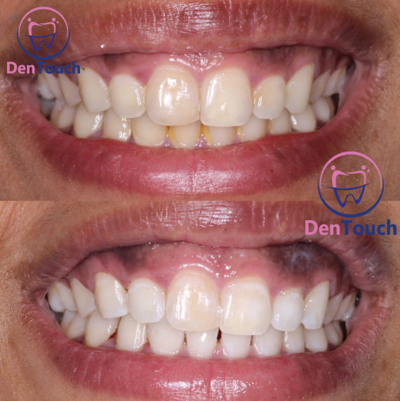 Stains and deposits on teeth