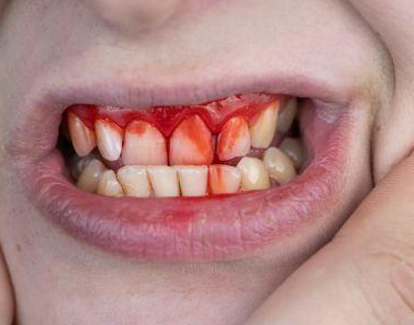Bleeding Gums