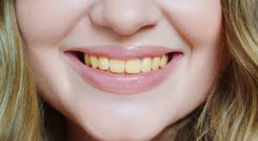 Discolored teeth