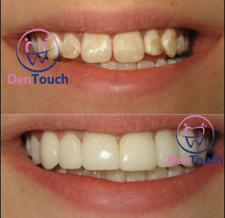 Discolored teeth