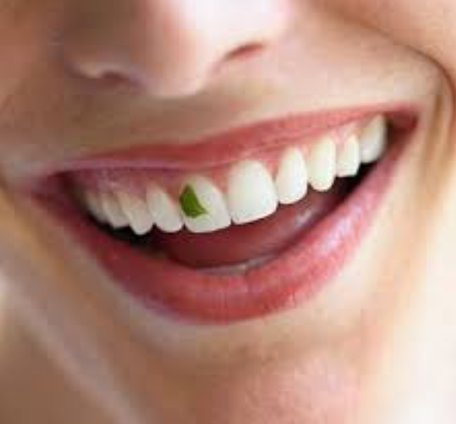 Food lodgement in teeth