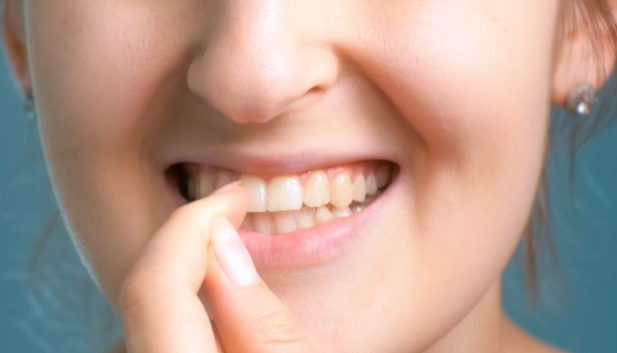 Food lodgement in teeth