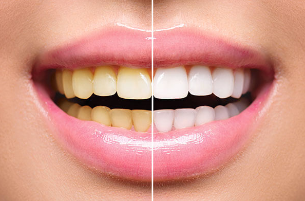 Stains and deposits on teeth