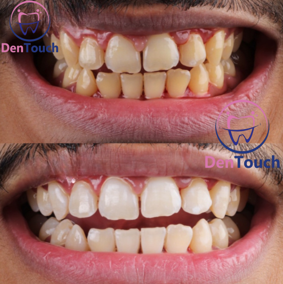 Stains and deposits on teeth