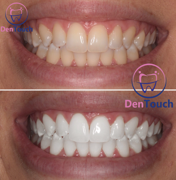 Teeth whitening