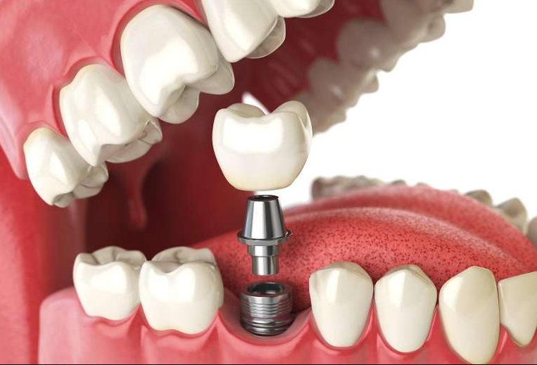 Dental Implants