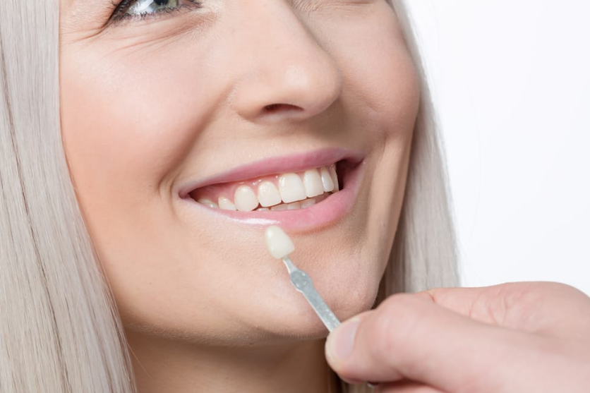 Personalised Veneers: Tailor Your Smile to Your Facial Features