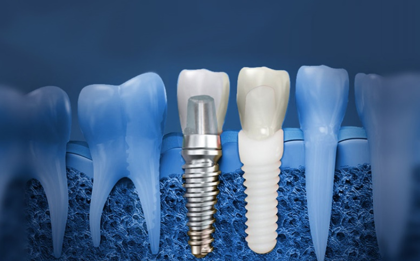 Dental Implants: Surgery, Purpose & Benefits