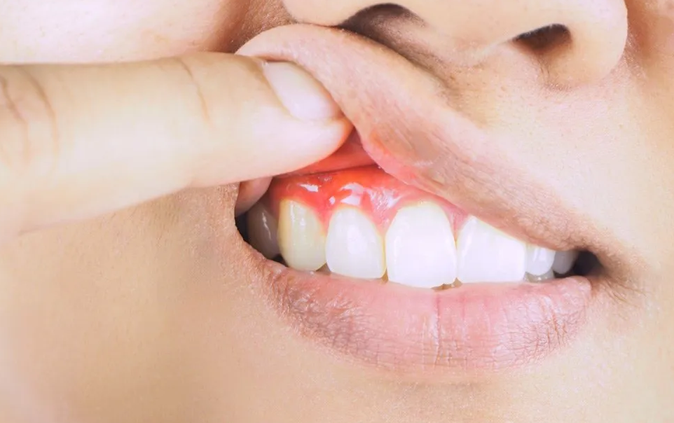 Treatment for all gum problem