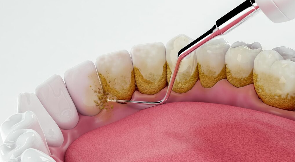 Mouth Cleaning and Polishing